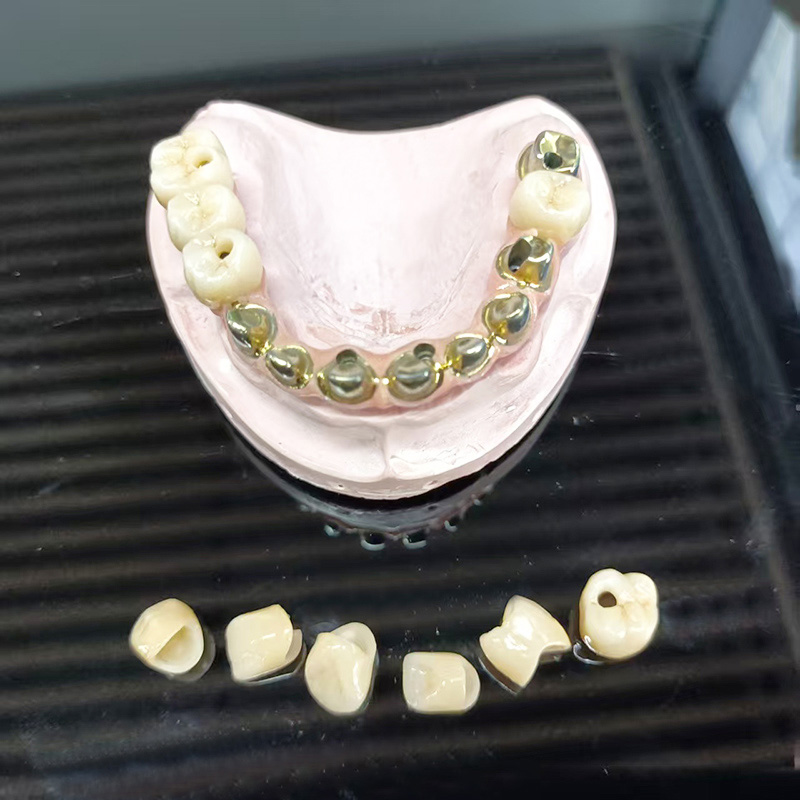 Täyskaareinen metalli-keraamisilta (PFM Full Arch Prothesis)